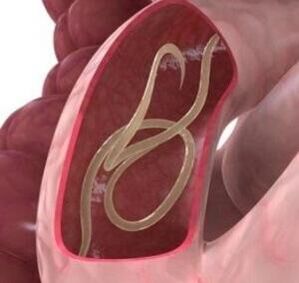 Os gusanos redondos son bastante comúns no intestino humano. 